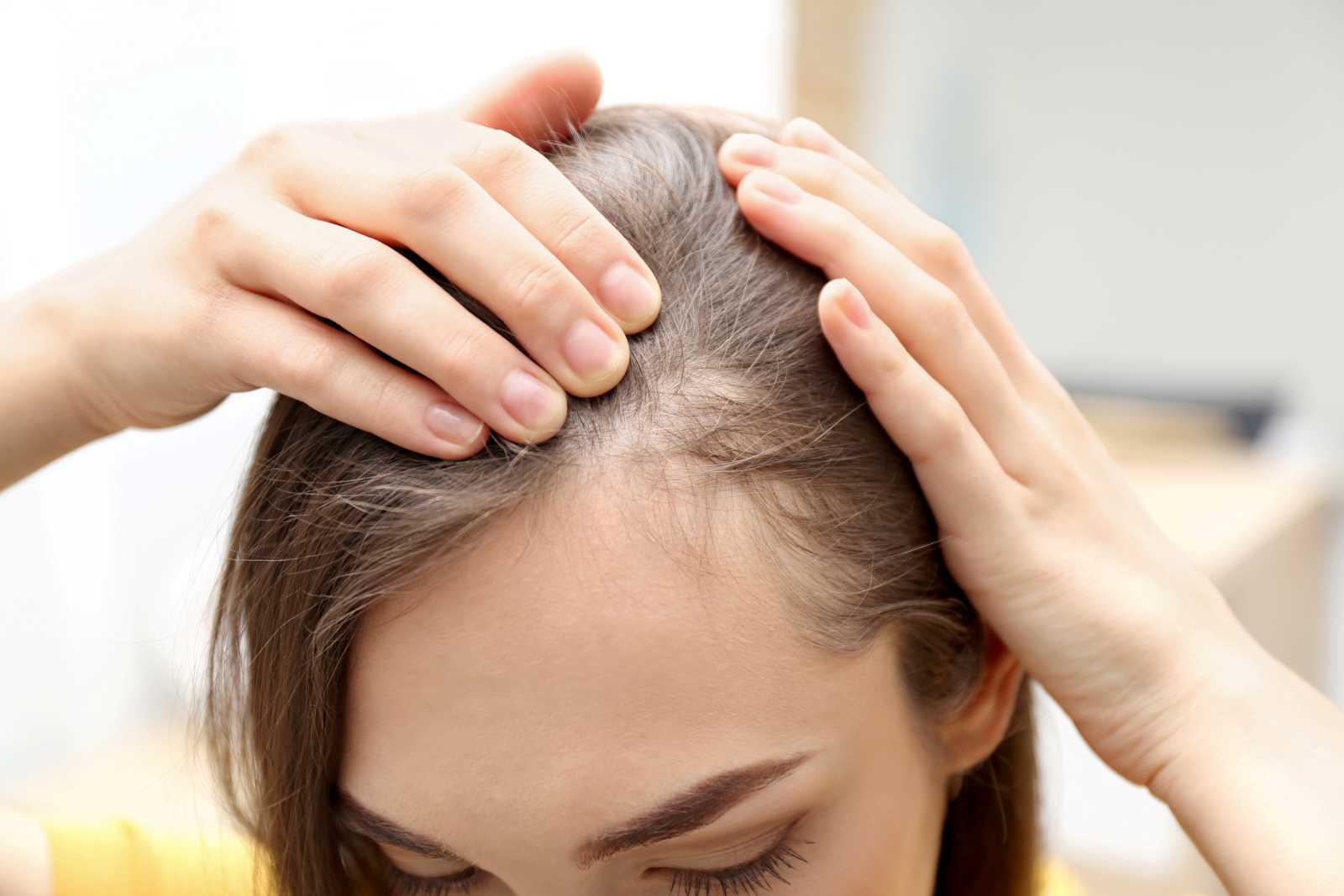 Alopecia Androgenética Femenina