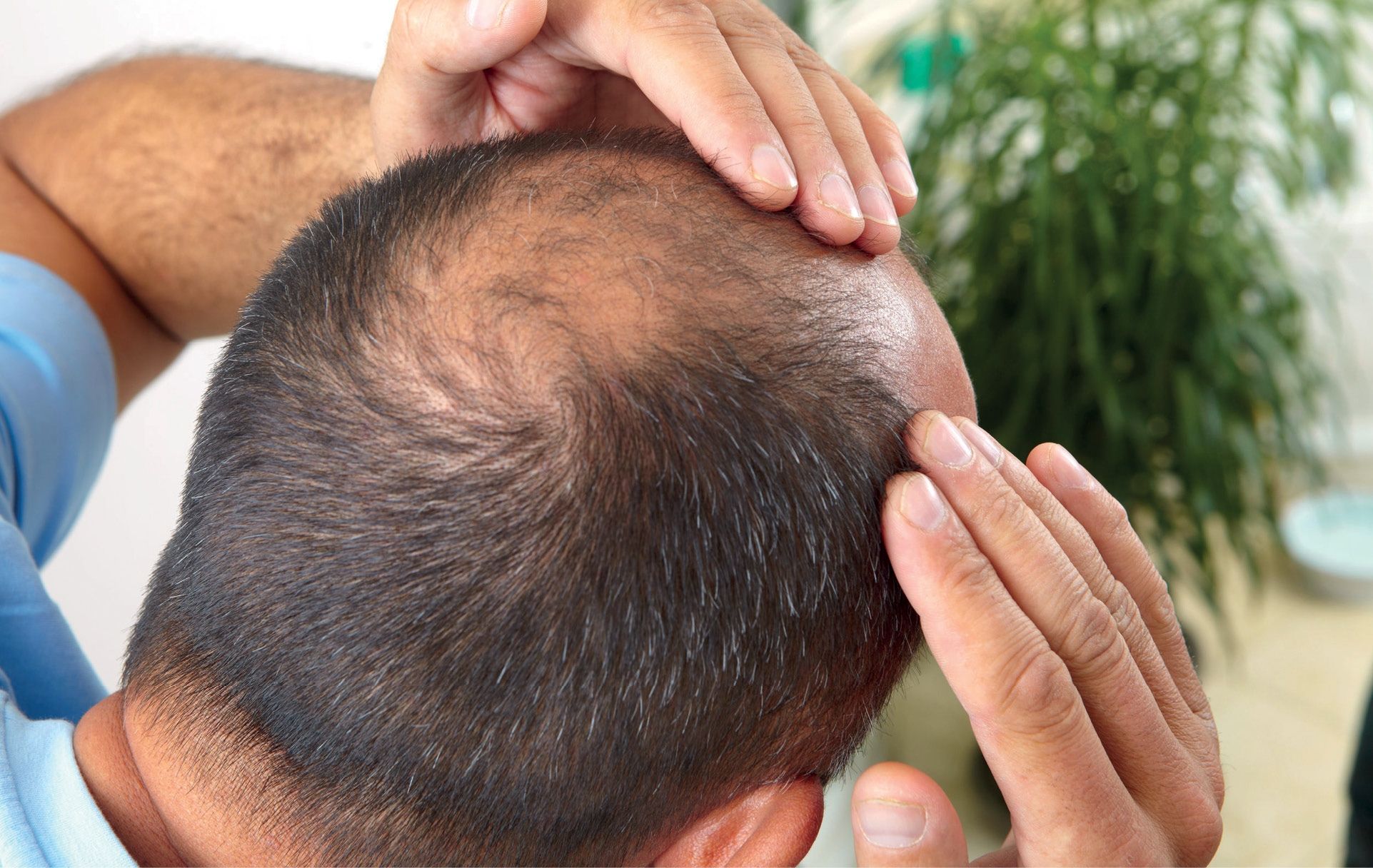 Alopecia Androgenética Masculina