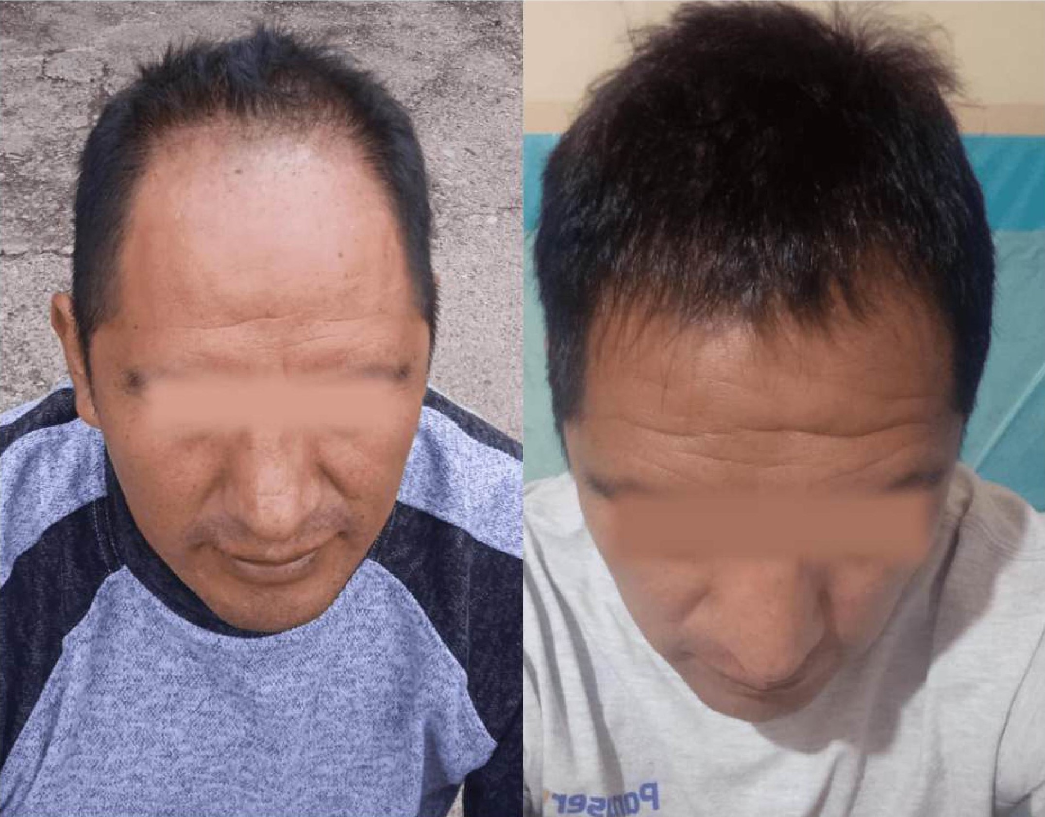 Antes y después Bruno Soto