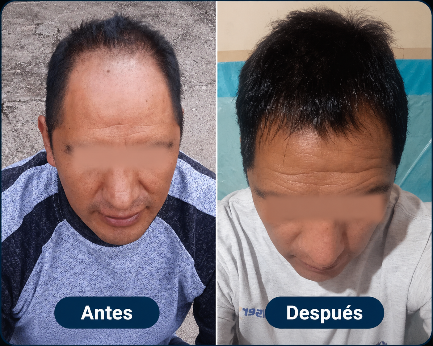 Resultado antes y después - caso 3